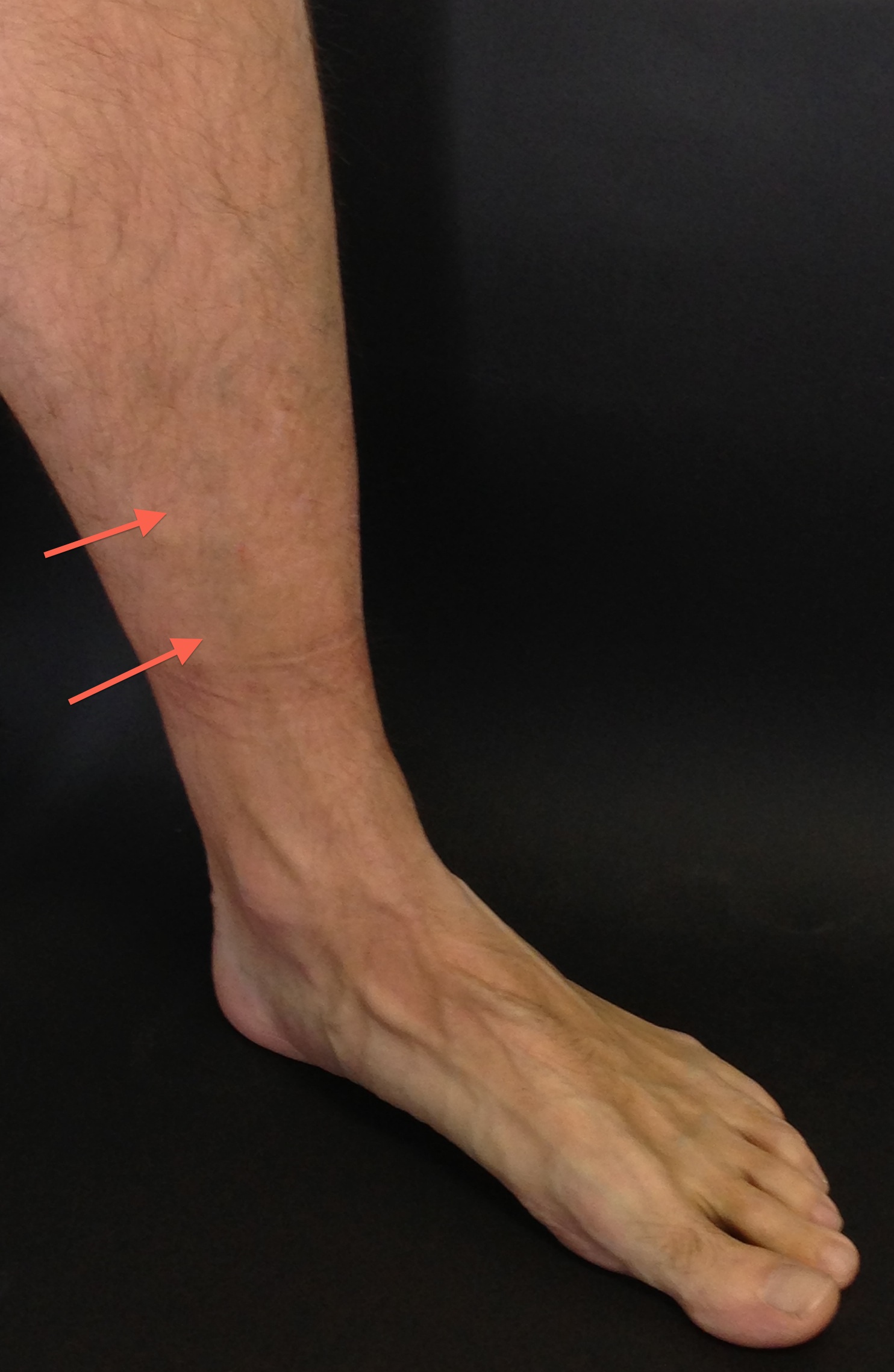 intermetatarsal neuroma